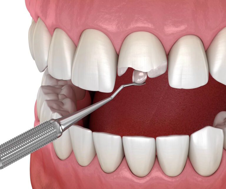 Fix Broken Tooth in Pasadena, CA - Pasadena Dental Office and Orthodontics